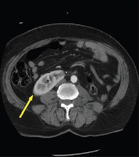 Single selected axial computed tomography scan image of the abdomen performed in the post-operative period shows resection of the large mass in the left part of the horseshoe kidney with organ preserving surgery. The right part is grossly unremarkable (arrow).