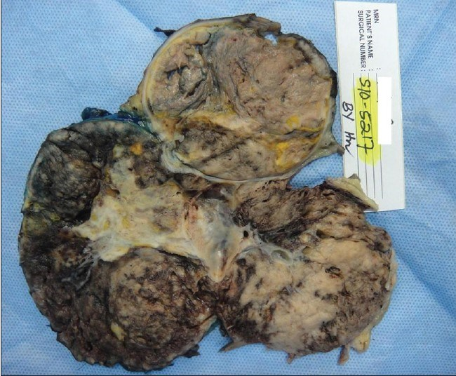 Pathology specimen shows a large multi-lobulated mass associated with an area of hemorrhage and cystic necrosis.