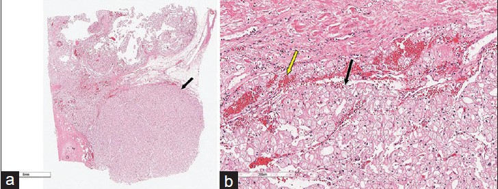 Hematoxylin and eosin stained slides of the clear cell renal cell carcinoma (RCC) mass in a horseshoe kidney. (a) At ×6 magnification shows the tumor margin (arrow) in relation to the reminder of the kidney, (b) At ×300 shows clear cells with prominent cell borders (black arrow) and vascularity (yellow arrow)