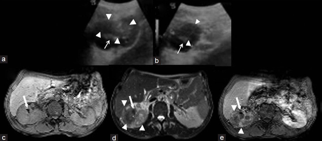 (a) Coronal and (b) axial ultrasound (US) imaging show intraparenchymal hypoechoic heterogenous solid mass with lobulated contour in the upper-middle portion of right kidney (arrowheads). (c) Axial T1-weighted magnetic resonance image (MRI), (d) T2-weighted image (WI) show an increase in the size of the right kidney and reveal a heterogenous hyperintense mass (arrowheads). (e) Post-contrast T1-WI reveals a homogenous isointense mass lesion invading renal sinusparenchyma, and the mass shows minimal enhancement after administration of intravenous contrast medium and note hyperechoic foci on US imaging and hypointense foci in all MRI sequences compatible with stones (white arrows).