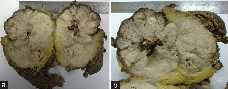 Cut sections of the nephrectomy specimen (a and b) after the right radical nephroureterectomy show an irregular gray-white solid tumor in total kidney and multiple yellow-brown colored staghorn stones. Surrounding renal parenchyma is not visible and the mass is seen invading perinephric and pelvic fat