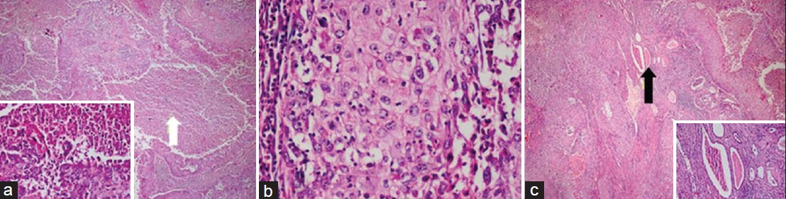 Histopathology samples stained with H and E, ×40 (a, b, c) show poorly differentiated squamous cell carcinoma of renal pelvis, extensively infiltrating the renal parenchyma and perinephric fat. (a) Sample shows intensive necrotic areas within tumor islands (white arrow). (b) Sample reveals tumoral tissue with atypical squamous epithelial cells. (c) Image demonstrates presence of residual renal tubule cells within the tumor islands (black arrow).