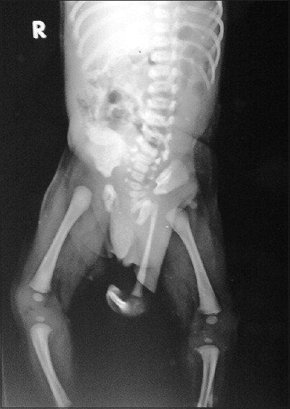 Radiograph of the patient reveals a normal left hip joint with an accessory left underdeveloped limb. The accessory limb has rudimentary femur falsely attaching to normal acetabulam of left hip joint. Both rudimentary femur and the tibia form a false knee joint. Distal most end of the accessory limb shows a single false digit with a single curved false metatarsal.