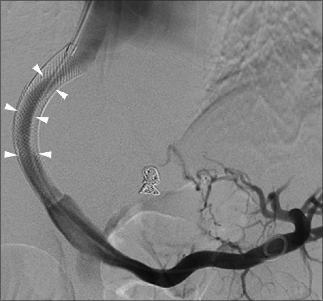 Intimal hyperplasia. 53-year-old man with refractory ascites 5-years after bare metal TIPS. Portal venogram reveals moderate intimal hyperplasia along mid-to-distal shunt (arrowheads). Balloon angioplasty resulted in widely patent stent.