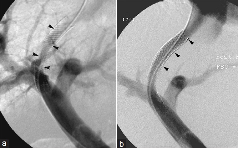 Intimal hyperplasia treated with shunt relining. 63-year-old man with intractable ascites 1-month after bare metal TIPS. (a) Venogram reveals in-stent stenosis (arrowheads). (b) Shunt relining with covered stent (arrowheads) results in improved flow and no residual stenosis.