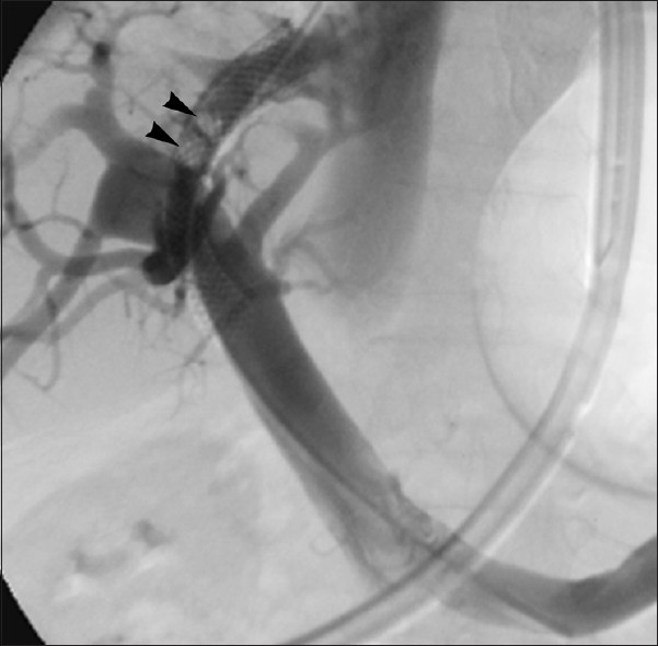 Intra-graft thrombus. 72-year-old man with recurrent variceal hemorrhage 24-hours after TIPS. Venogram shows thrombus formation (arrowheads) within parenchymal portion of shunt. Portography following balloon maceration revealed no evidence of residual thrombus.