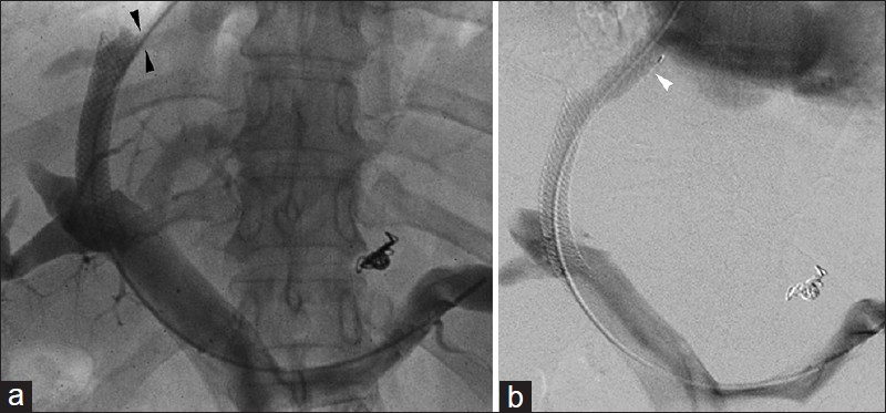 Bare metal TIPS hepatic venous end stenosis in 50-year-old man. Recurrent variceal hemorrhage 8-years post-TIPS prompted imaging. (a) Venogram reveals significant hepatic venous end stenosis (arrowheads). (b) Relining with covered stent (arrowhead) eliminated stenosis.