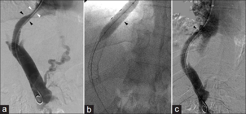 Covered stent TIPS hepatic venous end stenosis in 50-year-old man with recurrent varices 6-months after TIPS. (a) Venogram reveals hepatic vein narrowing (white arrowheads) between stent and inferior vena cava confluence; initial stent (black arrowheads) length inadequate. (b) Balloon angioplasty (arrowhead) of narrowed segment followed by (c) covered stent (arrowhead) deployment to extend the length of the shunt.