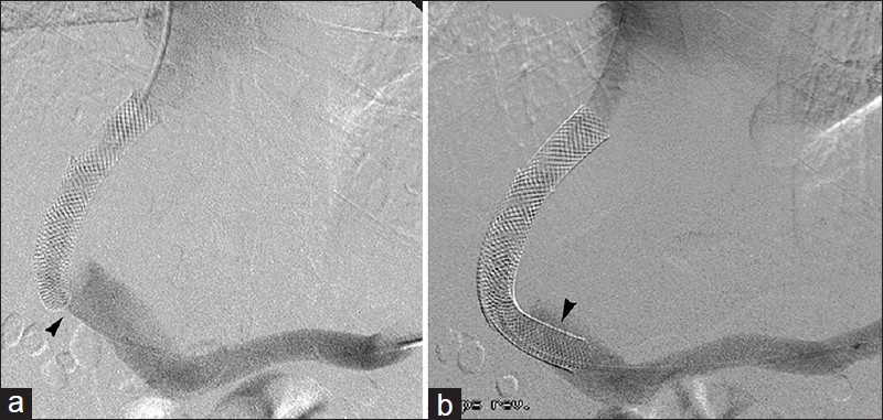 Portal venous end TIPS stenosis. 52-year-old man with recurrent ascites 3-years after TIPS. (a) Portal venogram reveals narrowed portal venous end (arrowhead). (b) Angioplasty and placement of a bare metal stenting (arrowhead) results in improved flow.