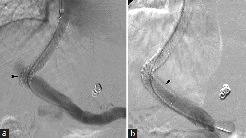 Abnormal shunt angulation. 59-year-old woman with recurrent ascites 1-year after TIPS. (a) Acute angulation of stent portal venous end (arrowhead) disturbs normal flow. (b) Extension of shunt with bare metal stent (arrowhead) improves angulation and flow.