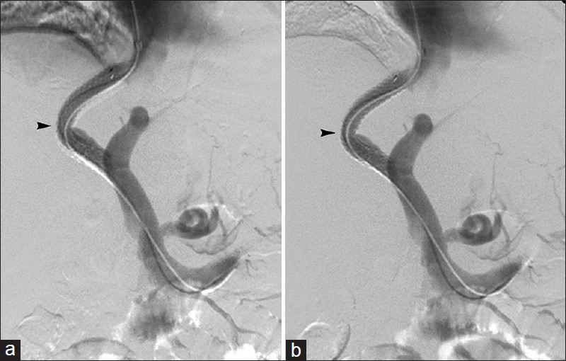 Porto-systemic gradient (PSG) elevation. 67-year-old man with recurrent ascites and elevated 20 mm Hg PSG 3-months after TIPS. Venogram (a) demonstrates widely patent TIPS (arrowhead). (b) Balloon angioplasty lowered PSG to 10 mm Hg with no change in angiographic appearance of shunt (arrowhead).