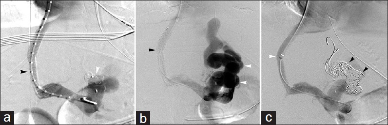 TIPS flow consolidation. (a) 49-year-old woman with variceal bleeding underwent TIPS (black arrowhead) with embolization of large gastroesophageal varix using metallic vascular plug (white arrowhead). (b) Venogram after recurrent bleeding demonstrates reduced flow through TIPS (black arrowhead) due to siphoning of blood by recanalized varix (white arrowheads). (c) Variceal embolization using metallic coils (black arrowheads) consolidated flow through TIPS (white arrowhead).
