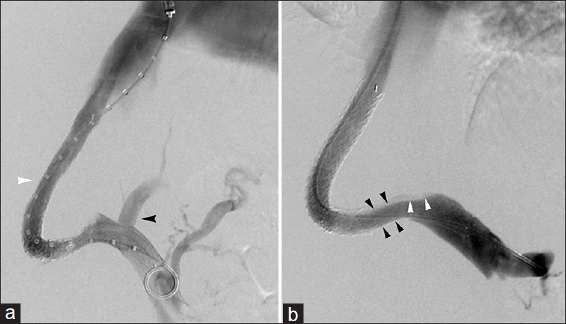 Pseudostenosis. (a) 57-year-old man with TIPS (white arrowhead) performed for refractory hepatic hydrothorax. Portal venography at time of shunt creation demonstrates antegrade flow in left portal vein (black arrowhead). Abnormal follow-up ultrasound flow velocity prompted (b) TIPS venogram which reveals pseudostenosis (black arrowheads) secondary to unopacified blood inflow (white arrowheads) from left portal vein, which showed physiologically reversed flow.