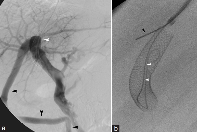 Back-end stiff guidewire technique for shunt access. (a) 51-year-old man with occluded TIPS (white arrowhead) and outflow via recanalized paraumbilical vein (black arrowhead). (b) Due to technically challenging TIPS access, operator embedded back-end of stiff guidewire into liver parenchyma (black arrowhead) to secure sheath and allow wire access into shunt (white arrowheads) for revision.