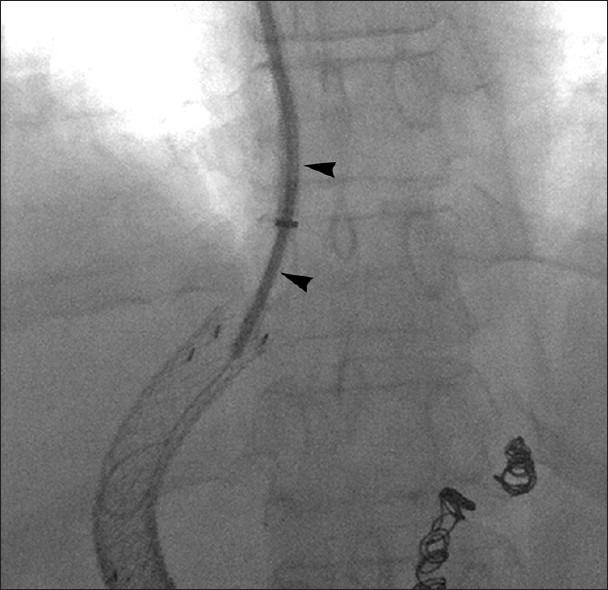 Metal transjugular cannula-supported shunt access. 60-year-old woman with occluded TIPS. 7 French angled stiffening cannula (arrowheads) advanced over guidewire to venous end of occluded stent. With cannula support, guidewire advanced through TIPS into portal vein, permitting successful revision.
