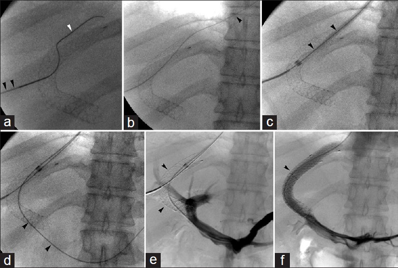 Percutaneous TIPS recanalization. 52-year-old man with bile leak-related TIPS occlusion. Operators failed access via transvenous approach, subsequently percutaneous recanalization approach was pursued. (a) Ultrasound-guided transhepatic needle (black arrowheads) access into occluded shunt followed by guidewire (white arrowhead) passage. (b) Wire (arrowhead) advanced into right atrium, and pulled out via internal jugular venous access using loop snare introduced into central circulation, establishing through-and-through access. (c) Sheath (arrowheads) then pulled into occluded TIPS, and (d) wire (arrowheads) guided into main portal vein. (e) Subsequent venogram confirmed TIPS occlusion (arrowheads). (f) Widely patent shunt following angioplasty and covered stent relining.