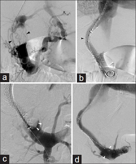 Portal vein tumor. 53-year-old man with hepatocellular carcinoma and refractory ascites. (a) Large portal venous tumor filling defect (arrowheads) present at time of TIPS. (b) TIPS restored portal vein patency and improved ascites. Symptomatic recurrence 4-months later prompted venography (c), which revealed new tumor invasion at portal aspect of shunt (arrowheads). (d) Successful TIPS recanalization after further covered stent extension (arrowheads).