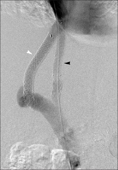 Optimization of clinical response with parallel TIPS. 58-year-old man with refractory ascites. Primary TIPS (white arrowhead) resulted in insufficient PSG reduction to 22 mm Hg. Creation of parallel TIPS (black arrowhead) reduced PSG to 7 mm Hg and resulted in marked clinical improvement.