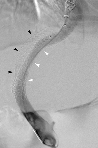 Shunt occlusion treated with parallel TIPS. 58-year-old man with recurrent variceal hemorrhage. Unsuccessful recanalization of occluded TIPS (black arrowheads) prompted placement of second TIPS spanning middle hepatic vein to left portal vein (white arrowheads).