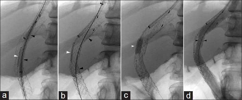 Liver failure treated with shunt reduction. 52-year-old woman developed rising bilirubin after 10 mm TIPS with 6 mm Hg final PSG. (a) 6 mm balloon expandable stent and 10 mm covered stent introduced in parallel into TIPS. (b) Covered stent deployed to pin balloon expandable stent, which was subsequently dilated to 6 mm (c). (d) Compression of covered stent by balloon expandable stent results in reduced shunt diameter (arrowheads), PSG increased to 15 mm Hg, and resolved liver failure.