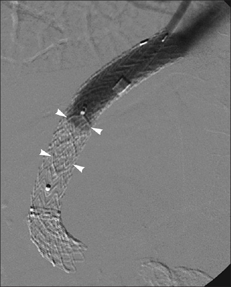 Refractory hepatic encephalopathy in 58-year-old man 1-month after TIPS. Hepatic encephalopathy following TIPS is usually transitory but in this case encephalopathy failed to resolve. It was decided to completely occlude the TIP shunt with 10 mm metallic vascular plug (arrowheads). Patient recovered from encephalopathy and discharged home.