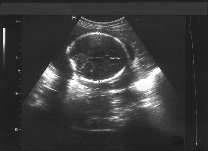 Ultrasound scan of abdomen shows how biparietal diameter is measured.