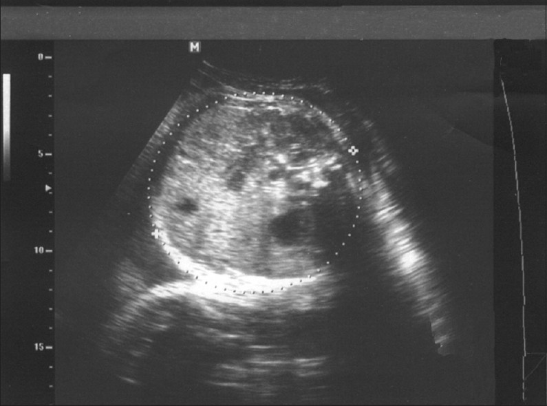 Ultrasound scan shows how to measure fetal trunk cross sectional area, using the four chamber view of the heart.
