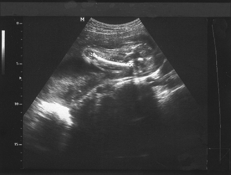Ultrasound scan shows how to measure femur length, with the ‘hook’ from the greater trochanter to the distal metaphysis included.