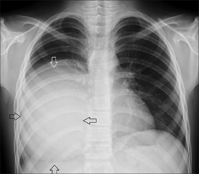 15-year-old male patient with frequent cough. Postero-anterior chest radiograph shows a very large dense homogenous opacity (arrows) in the right lower hemithorax.