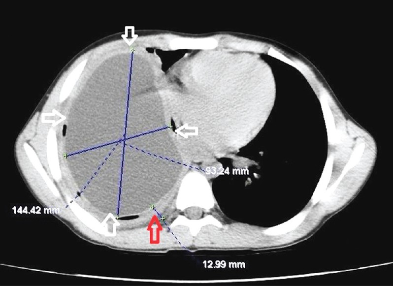 Giant pulmonary hydatid cyst. Axial computed tomography of chest (mediastinal window) reveals fluid containing giant cyst measuring 14.4 × 9.3 cm (white arrows) with a thick-enhancing wall (1.29 cm), (red arrow).