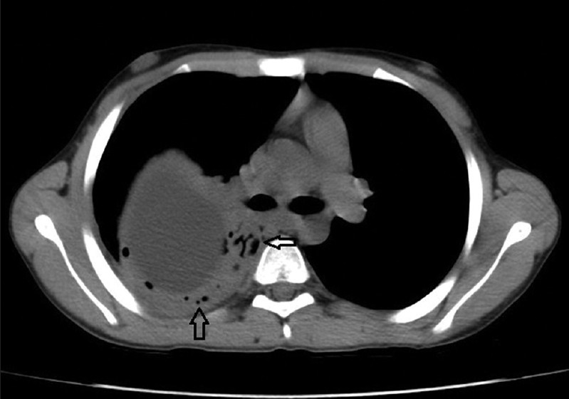 The “air bubble” sign. Axial computed tomographic scan of the chest (mediastinal window) shows air bubbles in regions surrounding the cyst (arrows).