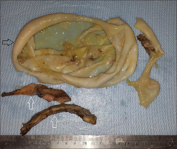 Pathology of the specimen. Macroscopic appearance of the resected hydatid cyst (black arrow) and adherent lung tissues (white arrows).