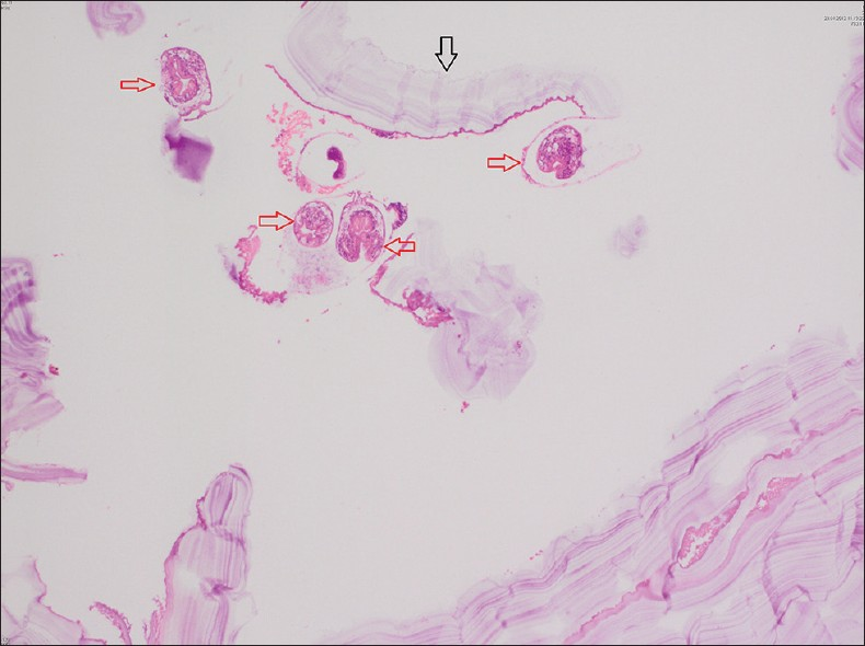 Microscopic examination. H and E, stained sample at ×40 magnification reveals the cyst wall with eosinophilic lamellar cuticular membrane (black arrow) and scolex of Echinococcus granulosus (red arrows).