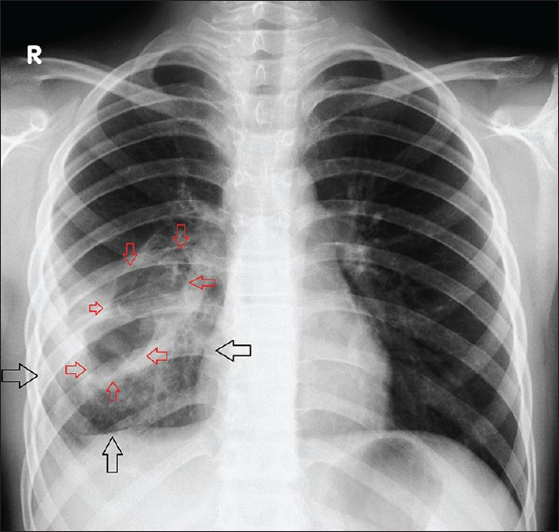 Postoperative postero-anterior chest radiograph of the case reveals complete expansion of the right lung (black arrows). Wedge resection additional to the cavitary procedure (capitonnage) was performed because of damage to the adjacent parenchyma of the involved lung caused by infection. Postsurgical change in the right lower lobe after surgical removal of the cyst (red arrows).