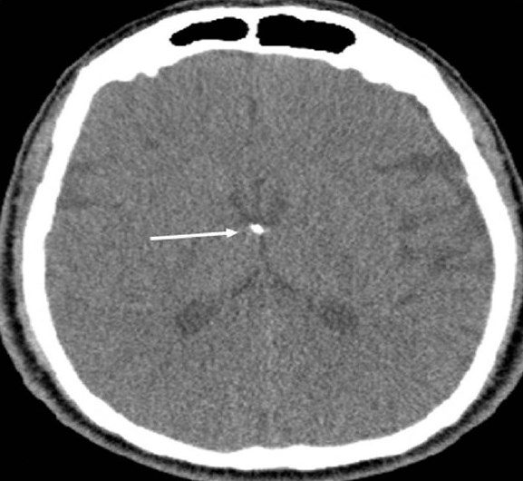 Neurofibromatosis Type 2. A 34-year-old man with mild hearing loss in the left ear. Axial computed tomography (parenchymal window) of the temporal bone shows subependymal calcification (arrow) at the foramen of Monro