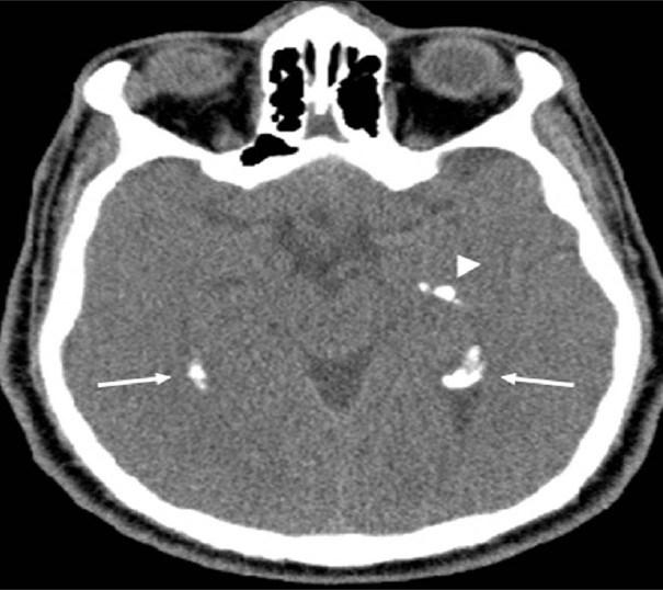 Neurofibromatosis Type 2. A 34-year-old man with mild hearing loss in the left ear. Axial computed tomography (parenchymal window) of the temporal bone shows extensive choroid plexus calcifications within both atria (arrows) extending into the left temporal horn (arrowhead)