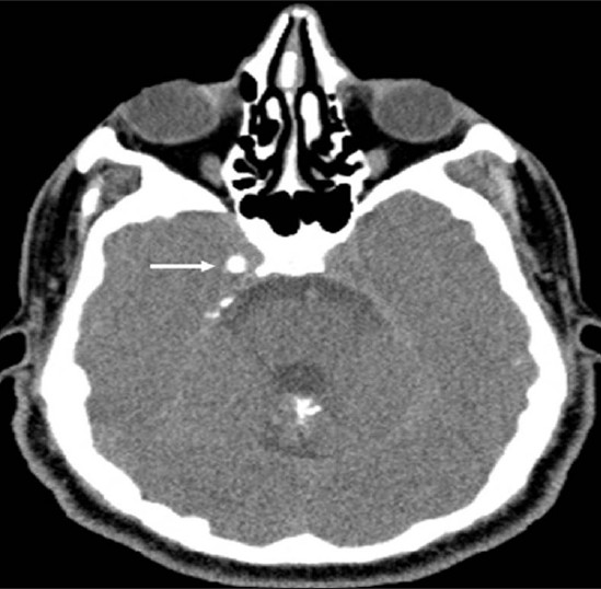 Neurofibromatosis Type 2. A 34-year-old man with mild hearing loss in the left ear. Axial computed tomography (parenchymal window) of the temporal bone reveals a small calcified lesion (arrow) adjacent to the right cavernous sinus