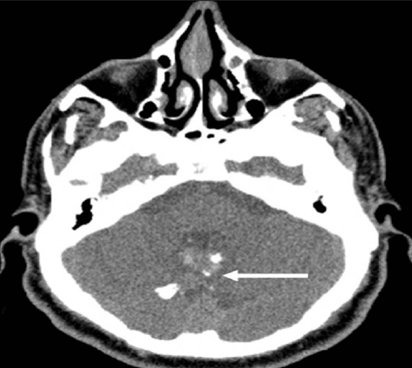 Neurofibromatosis Type 2. A 34-year-old man with mild hearing loss in the left ear. Axial computed tomography (parenchymal window) of the temporal bone shows a midline mass (arrow) with coarse calcifications at the posterior aspect of the fourth ventricle. Note the normal appearance of bilateral pontocerebellar cisterns