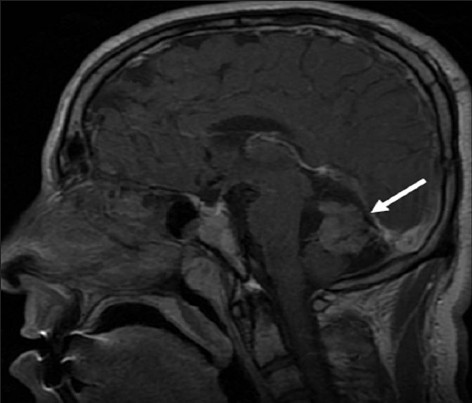 Neurofibromatosis Type 2. A 34-year-old man with mild hearing loss in the left ear. Cerebral magnetic resonance. Sagittal postcontrast T1-weighted image shows an enhancing midline mass (arrow) within the posterior fossa.