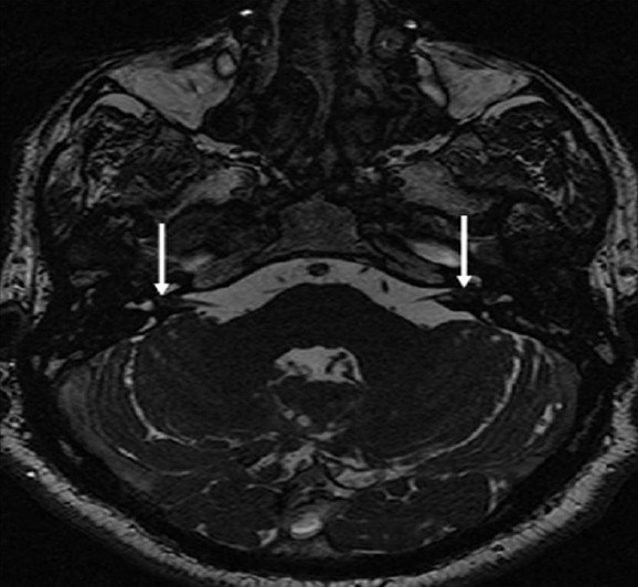 Neurofibromatosis Type 2. A 34-year-old man with mild hearing loss in the left ear. Inner ear magnetic resonance imaging. Axial fast imaging employing steady state acquisition image demonstrates small intracanalicular lesions (arrows) obliterating the fundus of the both internal acoustic canals