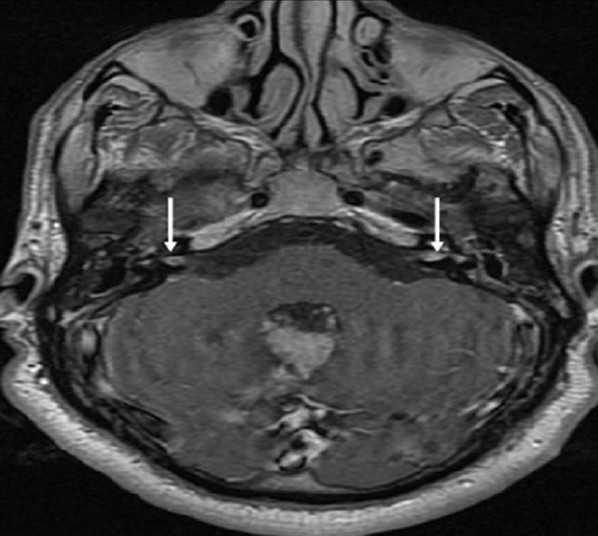 Neurofibromatosis Type 2. A 34-year-old man with mild hearing loss in the left ear. Inner ear magnetic resonance axial post-contrast T1-weighted image shows enhancement within the small tumors (arrows) of the both internal acoustic canals