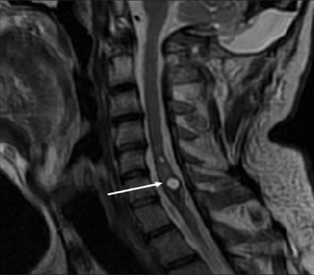 Neurofibromatosis Type 2. A 34-year-old man with mild hearing loss in the left ear. Cervical spinal magnetic resonance sagittal T2-weighted image shows a mass (arrow) causing cord expansion at C5-C6 level with cystic component and hemosiderin at caudal margin, which are typical findings of a cord ependymoma