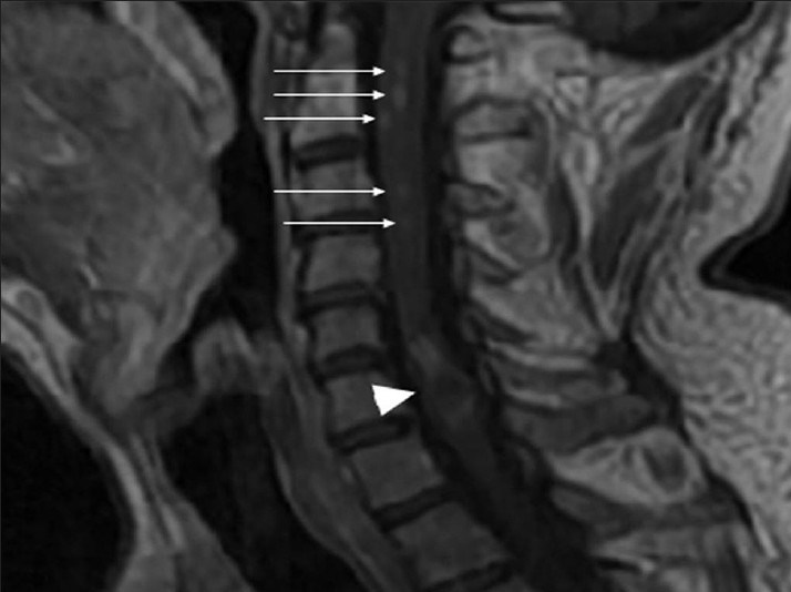 Neurofibromatosis Type 2. A 34-year-old man with mild hearing loss in the left ear. Cervical spinal magnetic resonance sagittal postcontrast T1-weighted image shows enhancement within the mass at C5-C6 level (arrowhead) and additional small intramedullary tumors with the appearance of “string of pearls” (arrows)