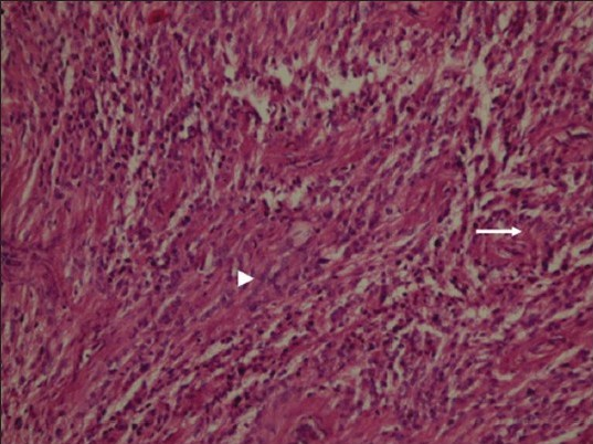 Neurofibromatosis Type 2. A 34-year-old man with mild hearing loss in the left ear. Photomicrograph of hematoxylin and eosin stained tissue at ×10 shows neoplastic ependymal cells with nuclear uniformity (arrowhead) and fibrillary cytoplasmic processes (arrow) remain attached to blood vessels, ×10)