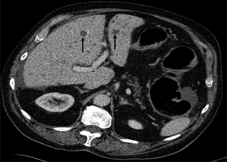 An 81-year-old man with adenocarcinoma of the colon and hepatic lesions later diagnosed as von Meyenburg complex. Axial enhanced CT image of the abdomen, at the level of the porta, demonstrate multiple fluid density lesions (arrows) of varying sizes within the liver. Fluid surrounding the liver is related to underlying large bowel obstruction.