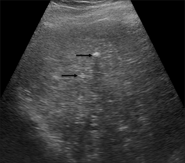 An 81-year-old man with adenocarcinoma of the colon. Hepatic lesions later diagnosed as von Meyenburg complex. B-mode ultrasound image of the liver shows several hyperechoic focal lesions (arrows).