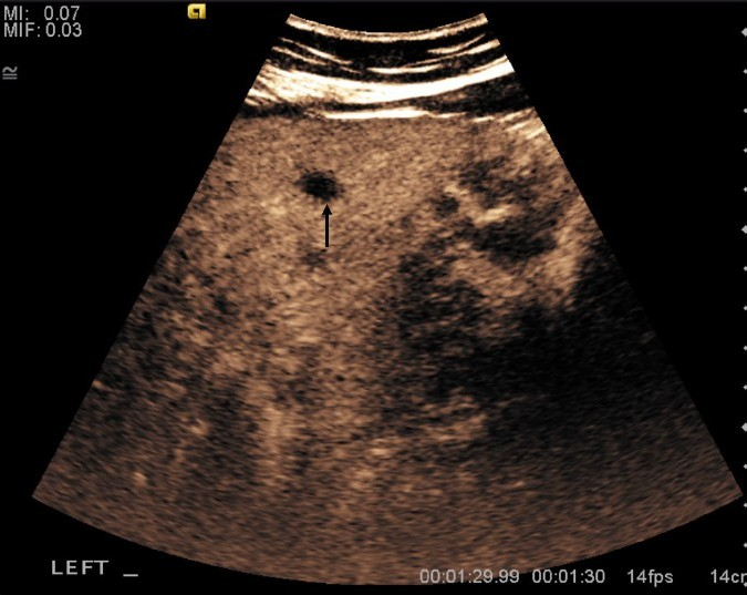 An 81-year-old man with adenocarcinoma of the colon and hepatic lesions later diagnosed as von Meyenburg complex. Contrast enhanced ultrasound of the liver in the late portal venous phase (1 min 30 sec following injection of contrast) demonstrates non-enhancing lesions (arrow).