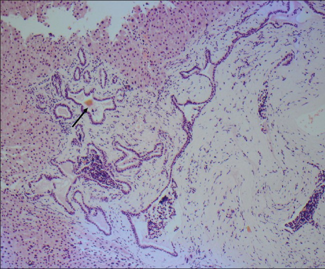 An 81-year-old man with adenocarcinoma of the colon and hepatic lesions later diagnosed as von Meyenburg complex. Hemotoxylin and eosin stained biopsy specimen shows dilated ducts with inspissated bile (arrow) in an expanded and fibrotic portal tract.