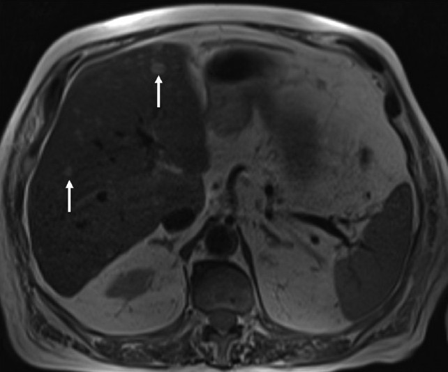 An 81-year-old man with adenocarcinoma of the colon and hepatic lesions later diagnosed as von Meyenburg complex. In T2-weighted MR sequence of the liver; the focal lesions exhibit high T2 signal (arrows).