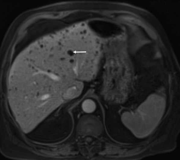 An 81-year-old man with colon cancer and lesions in the liver diagnosed as von Meyenburg complex. Post-contrast T1-weighted sequence demonstrate multiple non-enhancing lesions (arrow) throughout the liver.